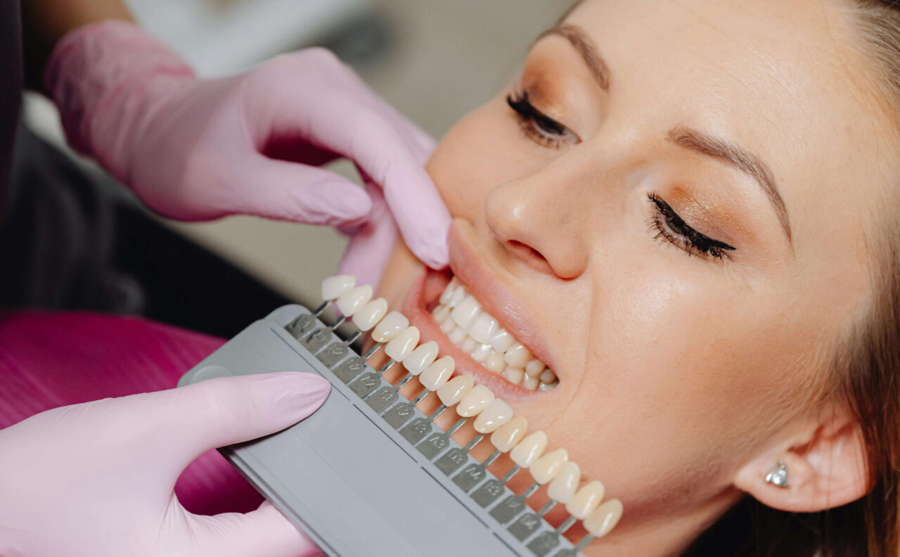 Blanqueamiento Dental